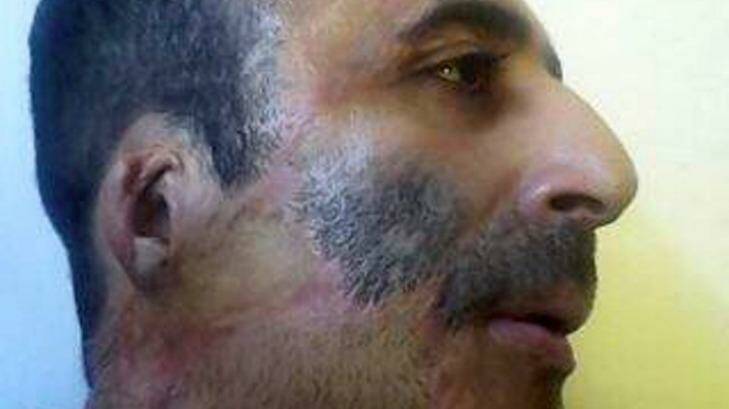 Burns victim Iranian man Majid Karami Kamasaei. Photo: Supplied