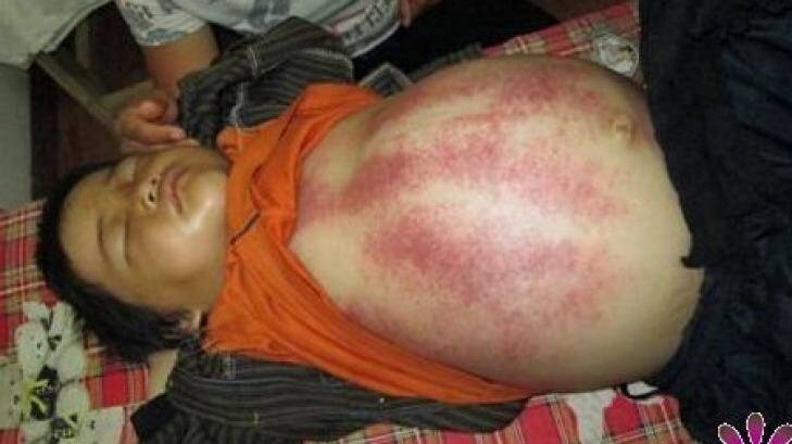 Mr Xiao's website claimed the bruises on this Nepalese eight-year-old were part of the healing process.  Photo: Supplied