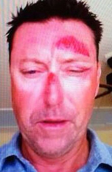 A photo Robert Allenby posted to Twitter of his injuries.