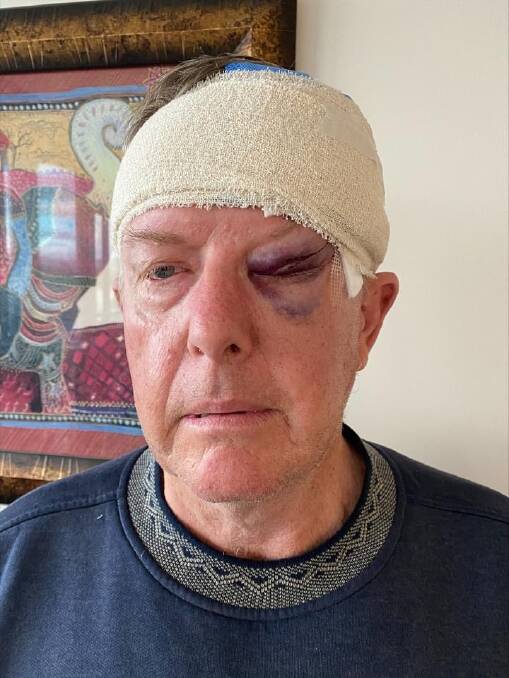 SUN PROTECTION: Parkes MP Mark Coulton after his surgery to remove a Basal Cell Carcinoma (BCC). Photo: SUPPLIED.
