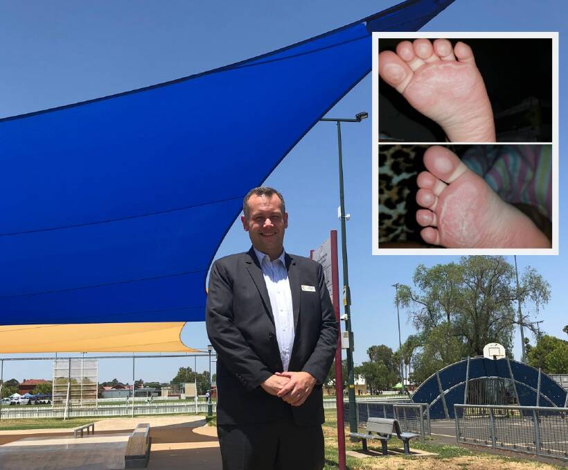 SHADE ON THE WAY: Dubbo Regional Council mayor Ben Shields at one of the play areas that already has a shade structure. Inset: A 16-month-old's feet were burnt last year while playing at one of the parks. 