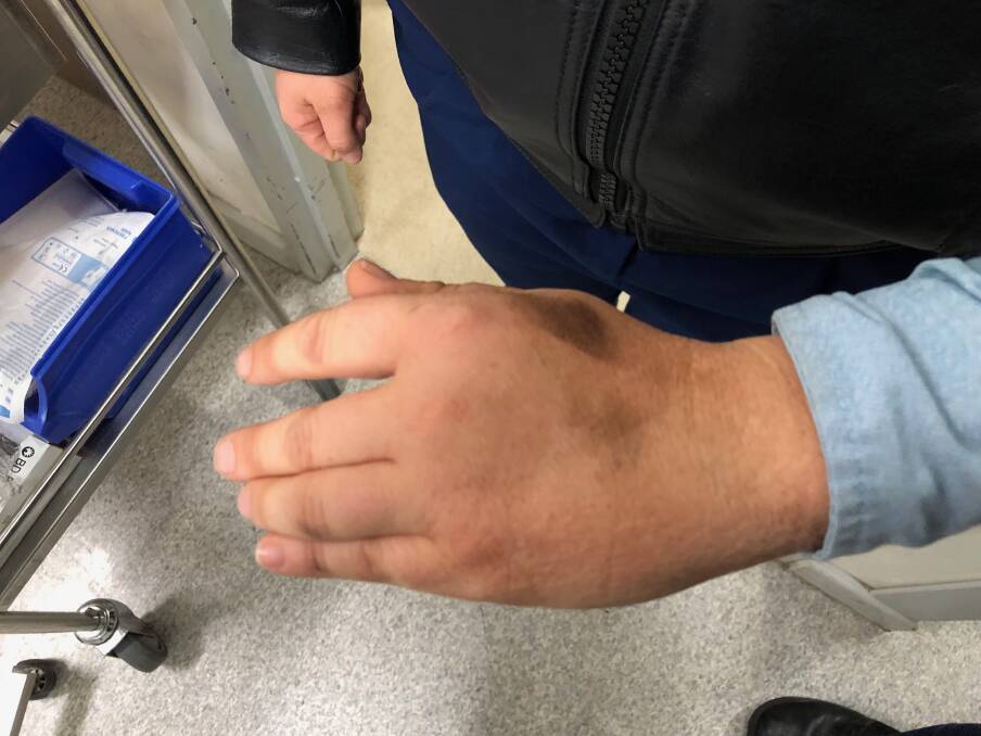 INJURIES: The female police officer's hand after the alleged assault took place. Photo: SUPPLIED