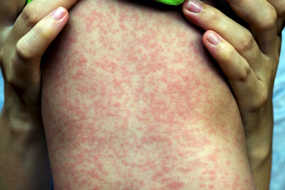 KEEP WATCH: The Western NSW Local Health District is urging Dubbo residents and doctors to keep watch for the signs and symptoms of measles. Photo: File