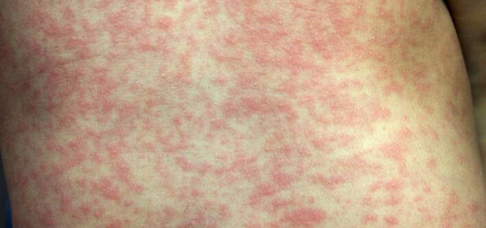 Measles symptoms include fever, sore eyes and a cough followed three to four days later by a red, blotchy rash spreading from the head and neck to the rest of the body. Photo: Shutterstock