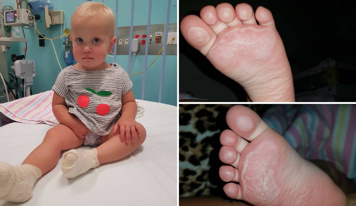 SIGNIFICANT BURNS: 16-month-old Maliah Corby suffered significant burns on her feet and toes after playing on the equipment at Elston Park. Photos: CONTRIBUTED