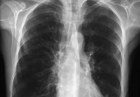 FATAL FLAW: The rate of fatal lung disease in the Western Plains is more than 70 per cent higher than the national average. Photo: FILE
