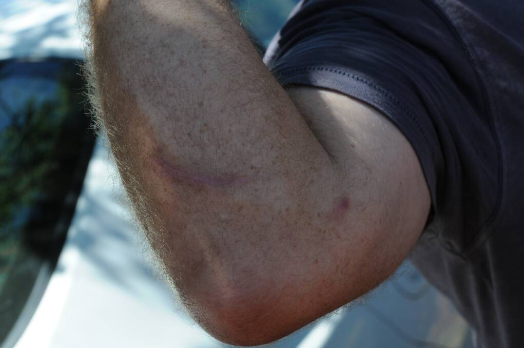 A man who owns a house in O'Donnell Street displays an injury he received when a backyard intruder attacked him while trying to get away from police. Photo: LISA MINNER.