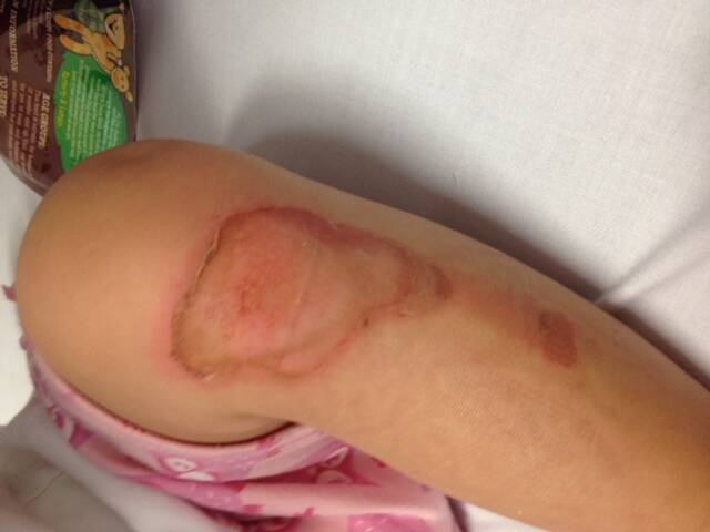 Baby Milla's burns. Photos: CONTRIBUTED